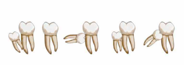 Different angles wisdom teeth can grow at Promenade Village Dental